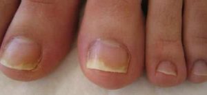 Rimedi di gente per prevenzione di un fungo di piede