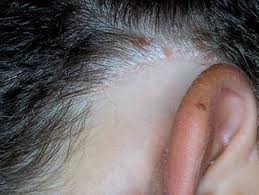 Quello che è caratteristico di eczema affilato su