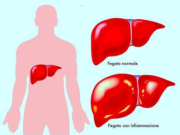 Fegato ingrossato