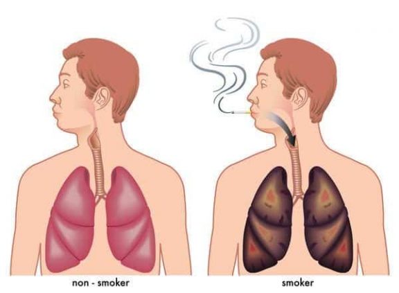 Polmoni di un fumatore