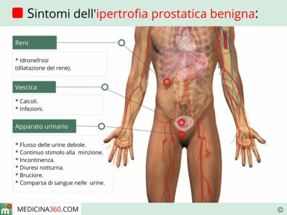 Ipertrofia prostatica