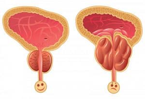 Ipertrofia prostatica rimedi ipertrofia-prostatica-rimedi