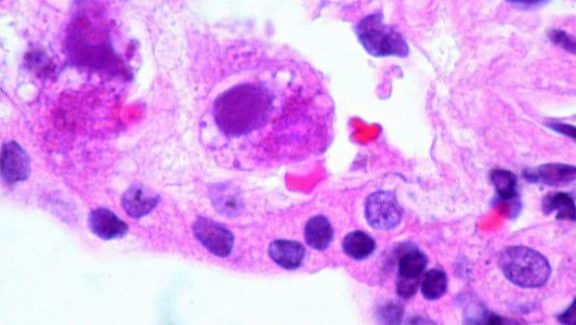 Citomegalovirus cura