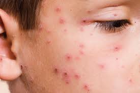 Varicella incubazione