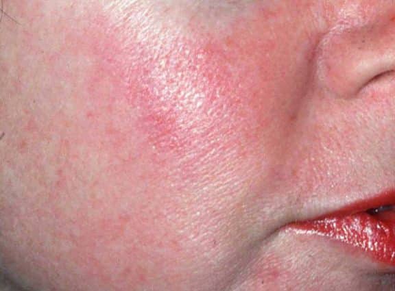 Rosacea viso