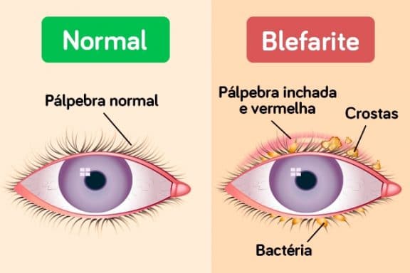 blefarite sintomi