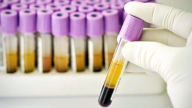 Leucociti alti nelle urine