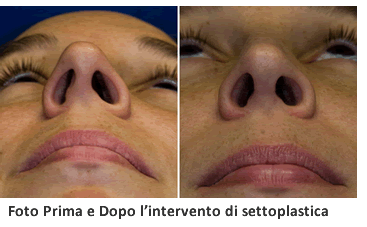 Setto nasale deviato operazione