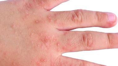 Come curare la dermatite