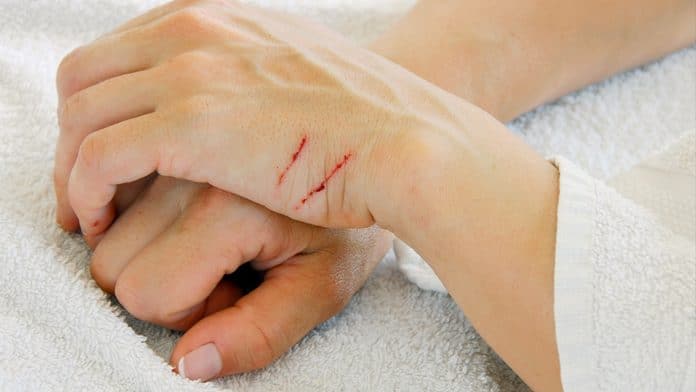 Bartonellosi Malattia Da Graffio Di Gatto Sintomi E Cosa Fare