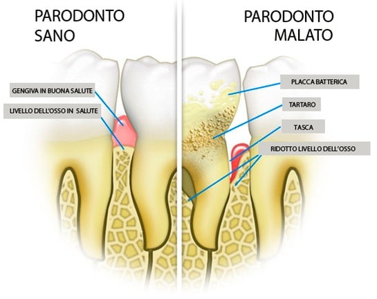 Parodontite cura