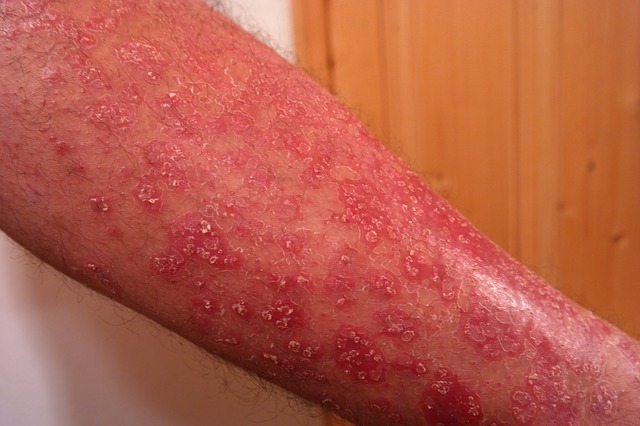 Psoriasi rimedi naturali